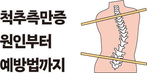척추측만증 원인부터 예방법까지